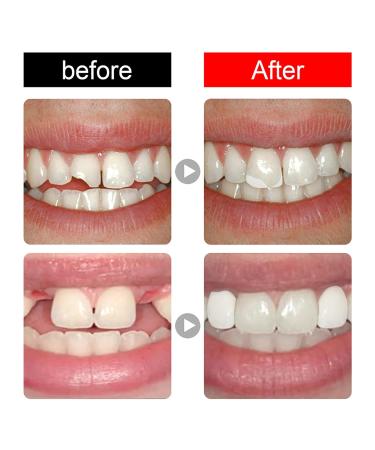 Temporary Tooth Caps & Crowns - Dental Repair Veneers for Front & Molar Teeth | 100 Pieces - Buy Online on GoSupps.com