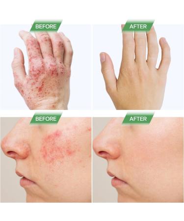 Buy Sugar-Free Eczema Treatment Gummies | USA-Made 10x Effective 20+ Vitamins for Eczema Psoriasis & Dermatitis - Healthy Skin Relief (60 Gummies - Buy Online on GoSupps.com