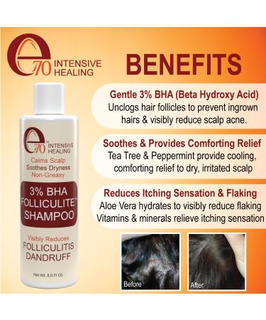 Folliculitis Treatment Set with Salicylic Acid | Shampoo Serum & Spray for Oily Scalp Dandruff & Flaky Skin - International Shipping - Buy Online on GoSupps.com