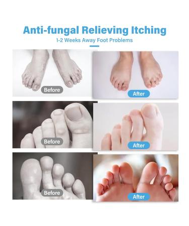 ItecFreely Athletes Foot Cream - Fast & Effective Treatment with Natural Ingredients - Buy Online on GoSupps.com