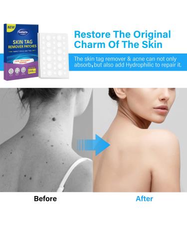 Skin Tag Remover Patches - 144Pcs | Safe & Painless Wart Removal for Face & Body - Buy Online on GoSupps.com