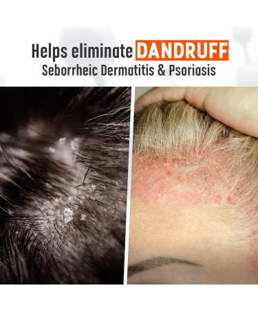 Medicasp Coal Tar Gel Dandruff Shampoo for Seborrheic Dermatitis & Psoriasis (6oz, Pack of 2) - Buy Online on GoSupps.com