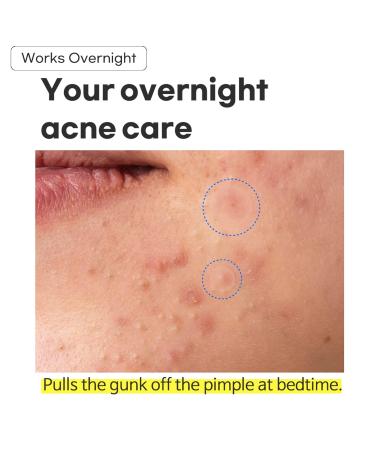 TIAM Surprise B Hydrocolloid Acne Pimple Patch - 96 Count (Pack of 4) | Fast Shipping Worldwide - Buy Online on GoSupps.com