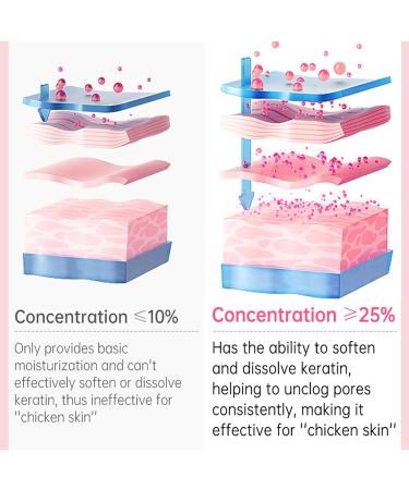 Keratosis Pilaris Lotion Leg Keratosis Pilaris Treatment Body Cream Skin Exfoliating Repair Cream Chicken Skin Care Cream Exfoliating Skin Body Lotion for Reduce and Smoothen Rough & Red Bump - Buy Online on GoSupps.com