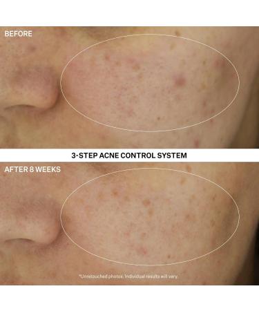 StriVectin Multi Action Clear Acne Treatment Set | 30-Day Trial Kit for Clearer Smoother Skin | Blemish Control & Breakout Defense - Buy Online on GoSupps.com