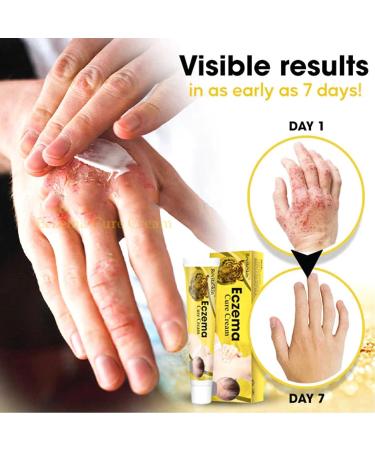 Chinese Herbal Eczema Treatment Cream - Sensitive Skin Relief (3pcs) - Buy Online on GoSupps.com