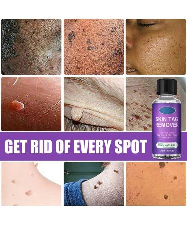 Skin Tag Removal Solution.(2PC 30ML) 2PC 30ml - Buy Online on GoSupps.com