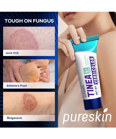 Tinea Versicolor Treatment Cream | Extra Strength Antifungal & Anti-Itch for Ringworm Athlete's Foot & Jock Itch | Natural Formula - Buy Online on GoSupps.com