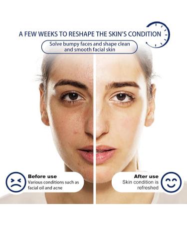  Luthasolic Akne Clean Foam Cleanser 170 g Acne Foaming Wash Akne Gentle Facial Cleansing Foam Deep Pore Cleansing Foam for Facial Cleansing Against Makeup Dirt (4%) - Buy Online on GoSupps.com