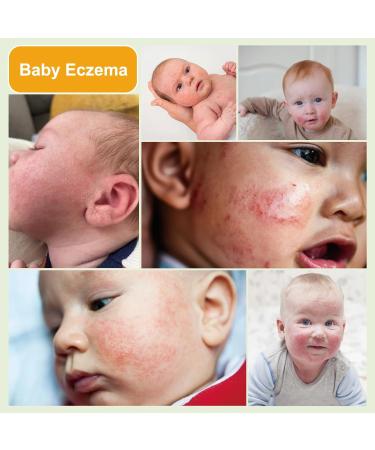 Baby Eczema Cream - Kids Eczema Therapy & Relief Body Cream, Nourishing Skin Protectant Soothes & Relieves Dry, Hypoallergenic, Fragrance & Steroid-Free (100ml_1pcs) - Buy Online on GoSupps.com