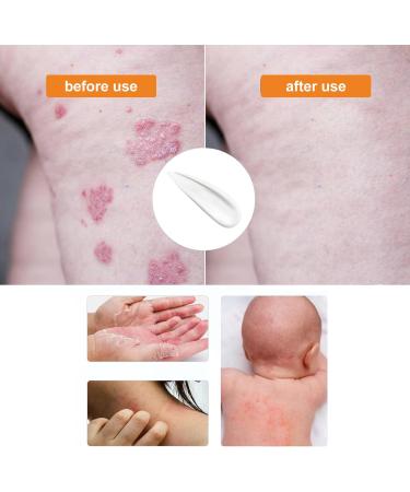 KRRHUEO Bee Venom Psoriasis Treatment Cream - Soothing and Moisturizing Skin Relief (1PCS) - Buy Online on GoSupps.com