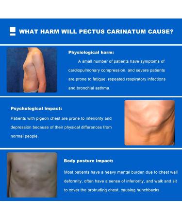 Pectus Carinatum Orthosis Brace - Sternum Protrusion Corrector Pigeon Chest Support for Adult Skin-Friendly and Breathable Will Not Move Freely Adjust the Size (Adult) - Buy Online on GoSupps.com