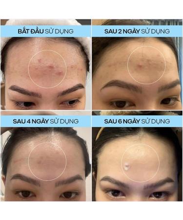 Facial Gel for Spots | Fast-Absorbing Lightweight Treatment to Repair and Eliminate Imperfections - Spot-Eliminating Facial Gel | For Girls Family Friends Colleagues Daily Use - Buy Online on GoSupps.com