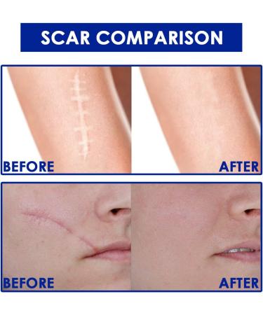 HEXILIN Gentle Scar Removal Cream for All Skin Types - Skin Repair and Diminish Scars, One Size - Buy Online on GoSupps.com
