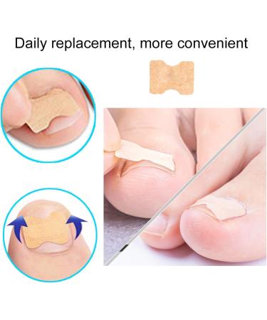Ingrown Toenail Correction 72 pieces Ingrown Toenail Bandage Sticker Patch Brace Ingrown Toenail Paronychia Corrector Breathable Strips Foot Care Pedicure Straightener Band Toenail Repair Tool - Buy Online on GoSupps.com
