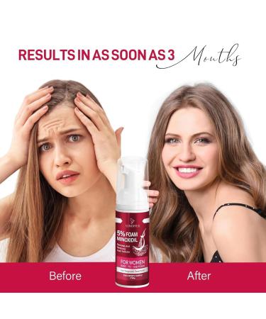 Women's 5% Minoxidil Foam - Hair Growth Treatment for Thicker Fuller Hair | 2 Pack (60g) - Effective Solution for Hair Loss - Buy Online on GoSupps.com