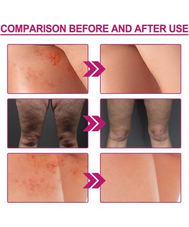  Nurvidis Acne Buttock Cream Buttock Pimple Cream Buttock Pimple Cream Restore Soft And Smooth Buttock Skin 100ml(B) - Buy Online on GoSupps.com