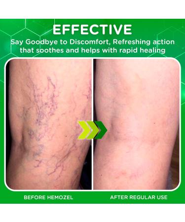 Dr. T HemoZel Cream Targets Visible Veins Skin Irritation Rashes Bruises & Dryness Lightweight Fast-Absorbing & Non-Greasy Formula Soothes & Moisturizes 1.38 oz (2 Pack) 1.38 Ounce (Pack of 2) - Buy Online on GoSupps.com