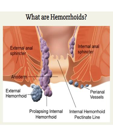 Heca Natural Herbal Hemorrhoid Capsules - Fast Relief for Pain & Discomfort (14 Pcs) - Buy Online on GoSupps.com