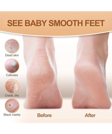 Foot Peel Mask 3-in-1 with Scrubber & Socks for Cracked Heels - 5 Pairs, 1.42oz x 5 - Foot Peel for Women & Men - Buy Online on GoSupps.com
