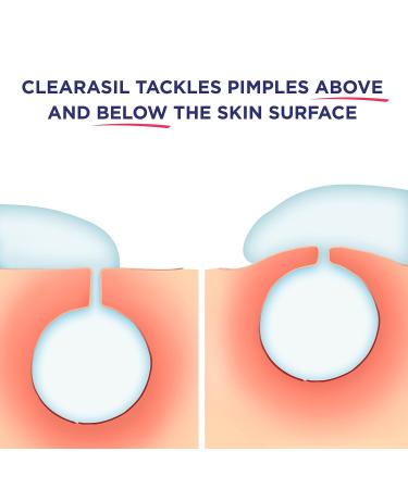 Clearasil Stubborn Acne Control 5 in 1 Spot Treatment Cream 1 oz - Maximum Strength Benzoyl Peroxide Medication for Blocked Pores, Pimple Size, Excess Oil, Acne Marks & Blackheads - Buy Online on GoSupps.com