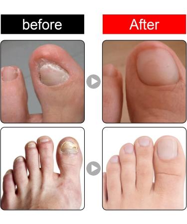 Ingrown Toenail Treatment Oil for Thick, Damaged Nails - Toenailplus Anti Paronychia Relief - Buy Online on GoSupps.com