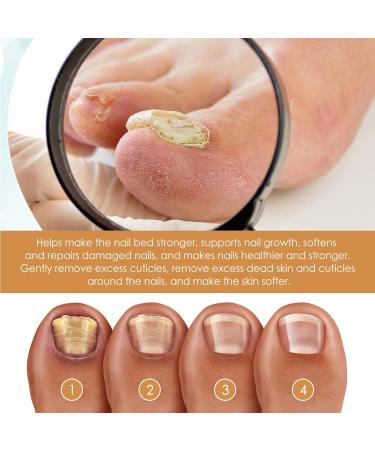 Cuticle Remover Gel 30ML Gentle Nail Care Cream for Softening and Moisturizing Cuticles - Buy Online on GoSupps.com