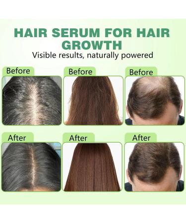 Syst me de repousse des cheveux s rum de croissance des cheveux s rum de croissance des cheveux micron pour amincir la perte de cheveux traitement pour plus pais renforce les racines renforce b - Buy Online on GoSupps.com