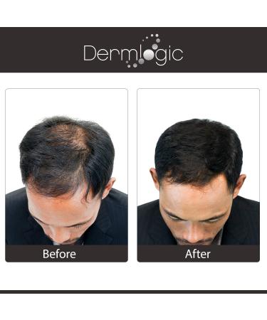 Extra Strength Hair Growth Serum - DHT Blocker for Fuller, Thicker Hair Growth - Men & Women, No Side Effects - Buy Online on GoSupps.com