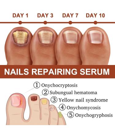 Nail Repair Essence Gray Nail Hand Foot and Nail Repair Liquid Restore Thickened Nail 20ml - Buy Online on GoSupps.com