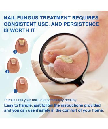 Fivfivgo Light Therapy Device for Nail Fungus Revolutionary Highly Efficient Light Therapy Device for Toenail Diseases Portable Device for Cleaning and Care of Nails - Buy Online on GoSupps.com