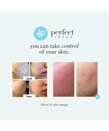 Lactic 50% Gel Peel - Chemical Exfoliant for Face Remove Breakout Scars Strength Level 2 1 oz - Perfect Image - Buy Online on GoSupps.com