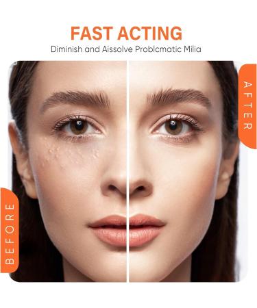 4Pcs Milia Clearing Essence Milia Remover Eye Serum Milia Remover Milia Spot Miliary Repair Essence Moisturize Skin Improve Skin Texture for All Skin Types 30ml/1fl.oz - Buy Online on GoSupps.com