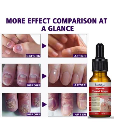 Nail Helper Ingrown Toenail Corrector - Drops for Toenail Correction & Growth Treatment | Fungal Nail & Cuticle Oil Care - Buy Online on GoSupps.com