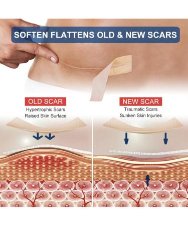 Medical Grade Silicone Scar Sheets - Professional Scar Removal Tape (1 x 120 Pack of 2) for Keloid C-Section Surgery & Burns - Reusable & Effective Treatment - Buy Online on GoSupps.com