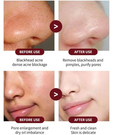 Fruit Acid Salicylic Acid Essence Fruit Acid Serum Salicylic Acid Serum Salicylic Acid Acne Treatment to Rejuvenate Skin Remove Acne Control Oil and Shrink Pores 30ml - Buy Online on GoSupps.com