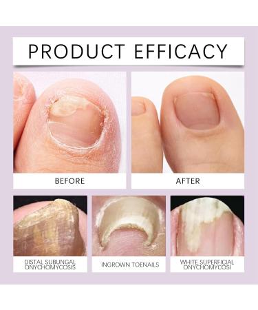 Bee Venom Nail Treatment Serum Natural Bee Venom Nail Serum Ingrown Toenail Treatment Drop Nail Growth and Repair Serum Fungal Nail Treatment Nail Fungus Treatment for Toenail - Buy Online on GoSupps.com