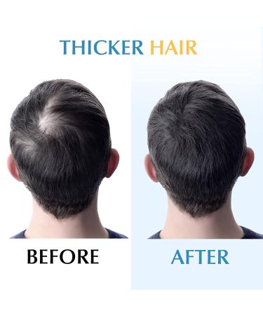 Derma Roller Microneedle Kit for Facial and Body Skin, Hair Growth and Scalp Treatment - Green - Buy Online on GoSupps.com