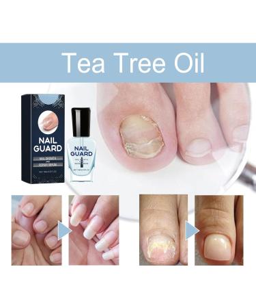 Onyxoguard Nail Growth and Repair Serum Best Nail Growth Serum Onyxoguard Serum Onyxoguard Nail Gel for Thin Nails and Growth (5pcs) - Buy Online on GoSupps.com