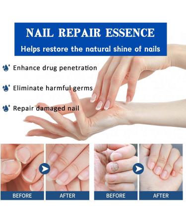 Fungal Nail Treatment 30ML Nail Fungus Serum for Toenail Extra Strong Gentle Anti Fungal Nail Serum Protects Thick Broken Discolored Nails Restoring Healthy Nails For Finger And Toe Nail Fungal - Buy Online on GoSupps.com