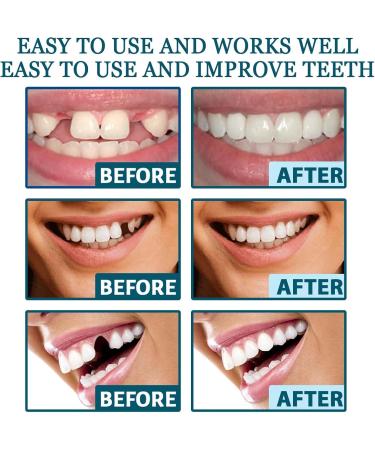 Adjustable Snap-on Dentures | Temporary Teeth Repair Kit for Correct Denture Alignment - Buy Online on GoSupps.com