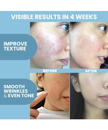 Eva Naturals Peptide Complex Serum + Microneedle Derma Roller - 0.25mm Titanium Derma Tool for Face & Scalp with Peptide Facial Serum & Derma Roller Bundle Serum + Dermaroller Bundle 2 Fl Oz (Pack of 1) - Buy Online on GoSupps.com