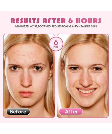 Vastcury Acne Patches with Natural Plant Extracts & Tea Tree Oil - 72 Hydrocolloid Dots for Acne Treatment - Buy Online on GoSupps.com