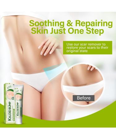 iTecFreely Keloid Scar Treatment for Nose & Belly Piercings - Silicone Scar Gel for Stretch Marks, Burns & Surgery Scars - Buy Online on GoSupps.com
