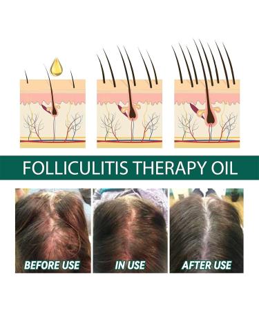 DUBUSH 2023 New scalp folliculitis therapy oil natural scalp therapy hair oil nourishing treatment oil for split ends and dry scalp for hair growth and skin care - Buy Online on GoSupps.com