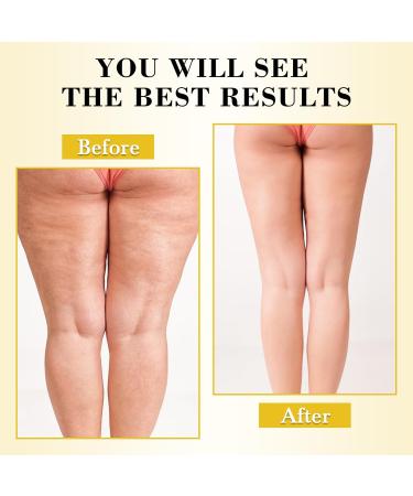 Anti-Cellulite Massage Oil with Massager - Natural Collagen & Stem Cell Skin Tightening Oil for Legs & Butt 8 Fl Oz | Effective Cellulite & Stretch Mark Remover - Buy Online on GoSupps.com