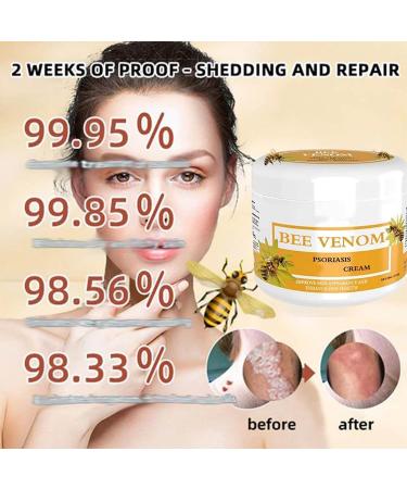 RENTANAC Bee Venom Psoriasis Cream Bee Venom Cream Psoriasis Cream New Zealand Bee Venom Cream Honey Bee Psoriasis Cream for Women Men - Buy Online on GoSupps.com