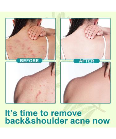 BAInuai Acne Backacne spray acne treatment spray acne spray for back and body tea tree oil for back acne solution 120 ml - Buy Online on GoSupps.com