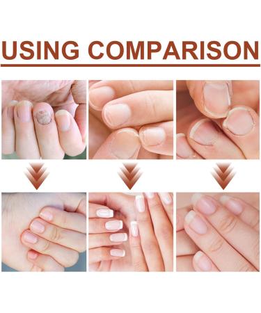GFOUK 7 days Nail Growth and Strengthening Serum for Thin Nails Nail Growth and Strength Serum Nail Cuticle Oil Strengthener Stronger Nails in 1 Week Nail Strengthening Treatment (2 pcs) - Buy Online on GoSupps.com