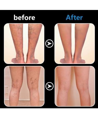  MagiSel Varicose Vein Cream Varicose Vein Cream Cream for Varicose Veins Varicose Vein Leg Treatment Suitable for Spider Veins Improves Blood Circulation Quickly Relieves Tired Legs 20g - Buy Online on GoSupps.com